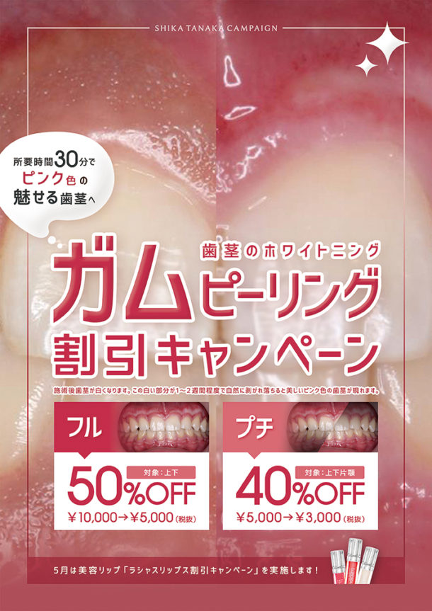 歯科医院キャンペーンポスター「ガムピーリング割引キャンペーン」